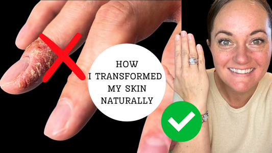 4 Steps to FIX, Dry, IRRITATED, Eczema HANDS This Winter