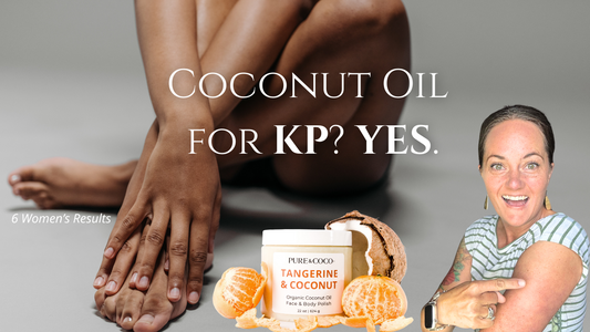 Coconut oil polish for keratosis pilaris relief—YouTube thumbnail with smooth legs, skincare jar, and woman showing bumpy arm results.