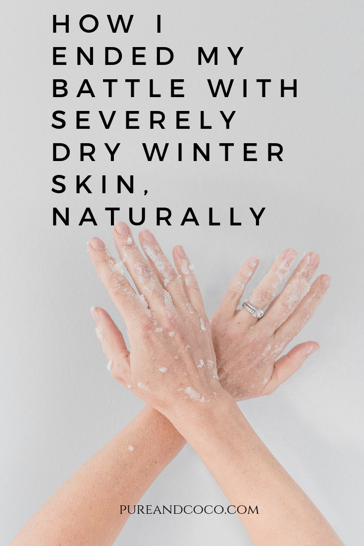 How I Treated the Eczema On My Hands, Naturally