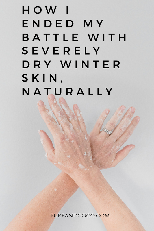 How I Treated the Eczema On My Hands, Naturally