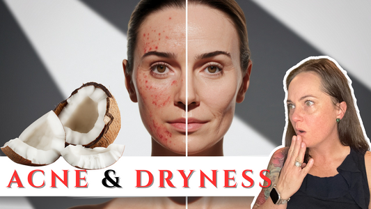 Does Coconut Oil Actually Help With Acne AND Dry Skin?