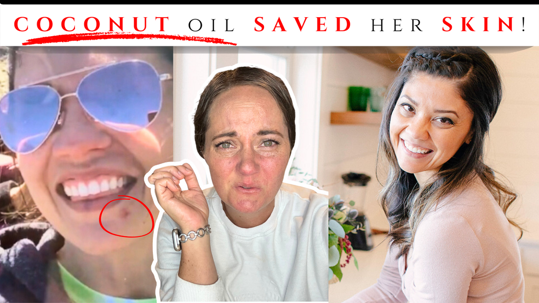 Eczema On Her Face & Coconut Oil Skincare [This Woman’s Journey]_pure and coco