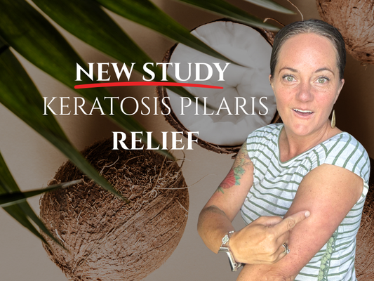 Woman pointing to keratosis pilaris bumps on arm next to headline ‘New Study – Keratosis Pilaris Relief’ with coconuts in background. Pure & Coco natural coconut oil polish shown as KP treatment for bumpy arms, chicken skin, and dry sensitive skin.