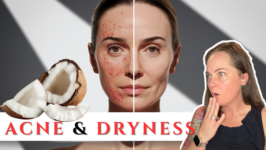 Does Coconut Oil Actually Help With Acne AND Dry Skin?