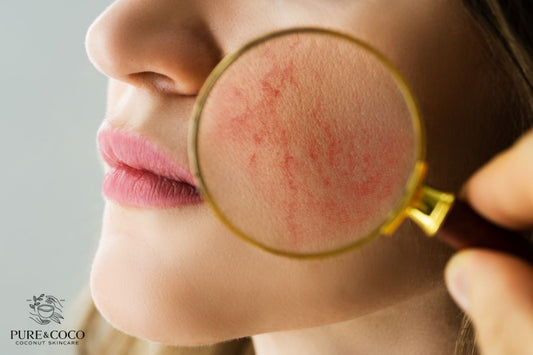 rosacea and eczema skin type blog and how to naturally treat both by pure and coco